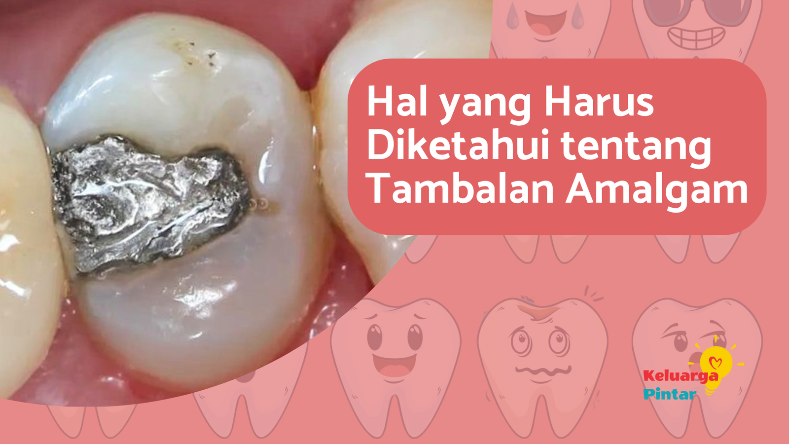 You are currently viewing Hal yang Perlu Anda Tahu Tentang Tambalan Amalgam